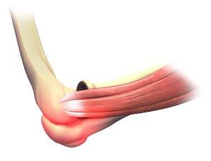 elbow condition 