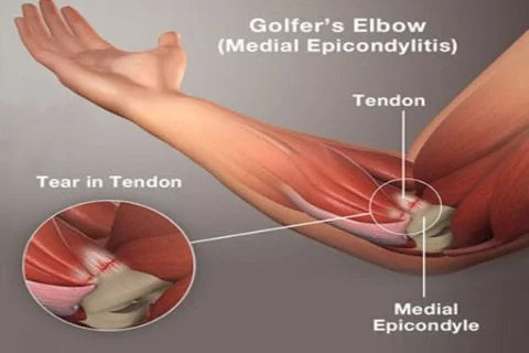 elbow condition 