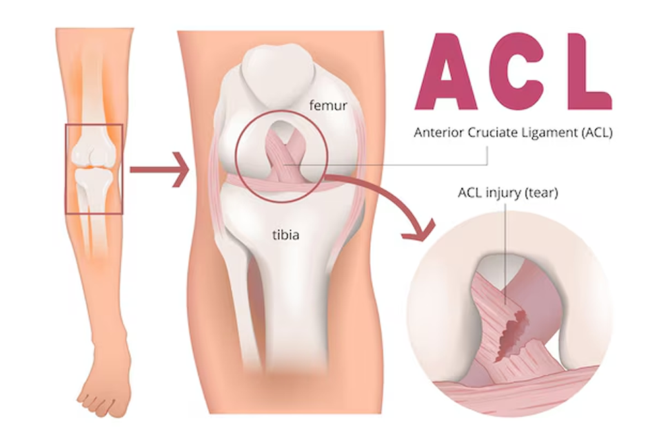ACL Reconstruction Hamstring Tendon