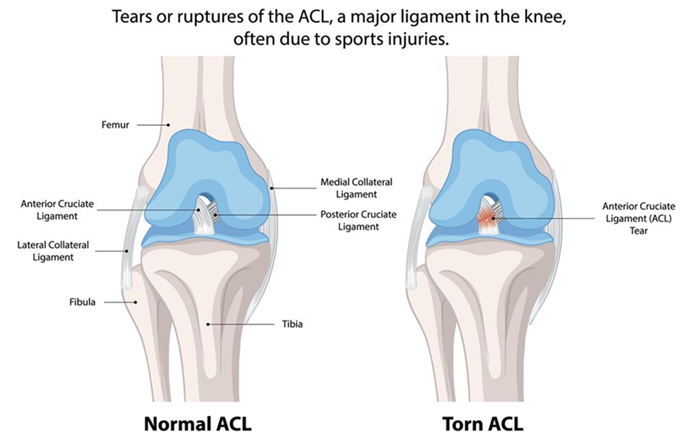 ACL Reconstruction Patellar Tendon