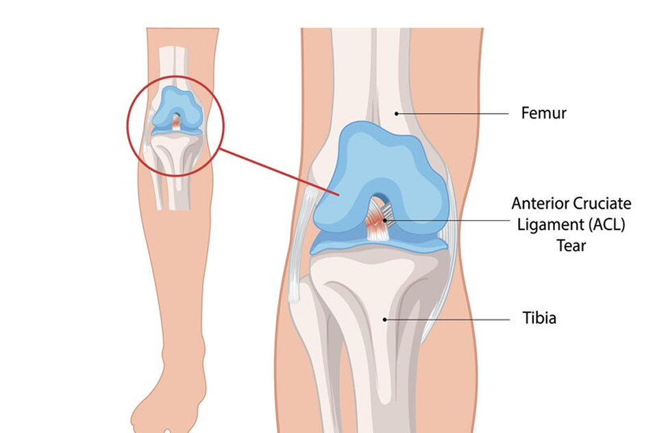 Anterior Cruciate Ligament Reconstruction