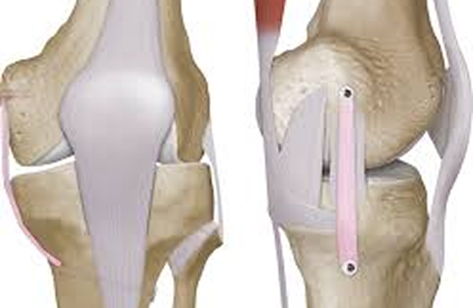 Medial Collateral Ligament Reconstruction