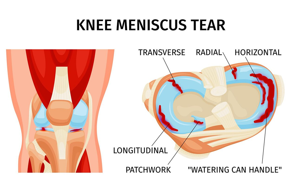 knee condition 