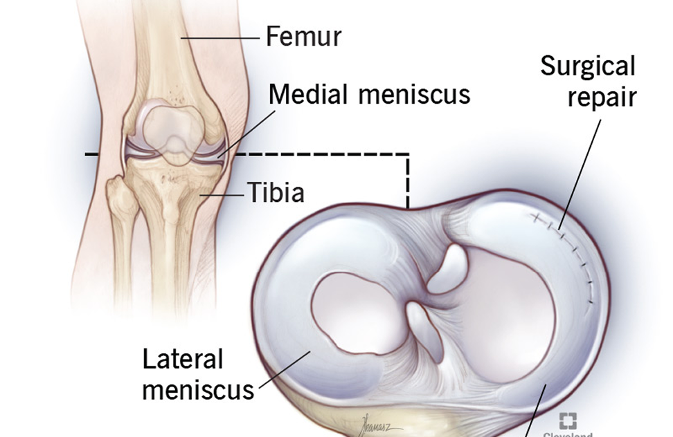 Meniscus Surgery