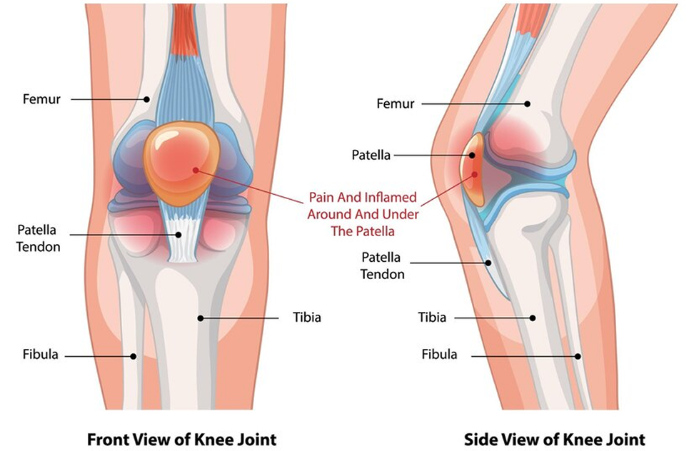 knee condition 